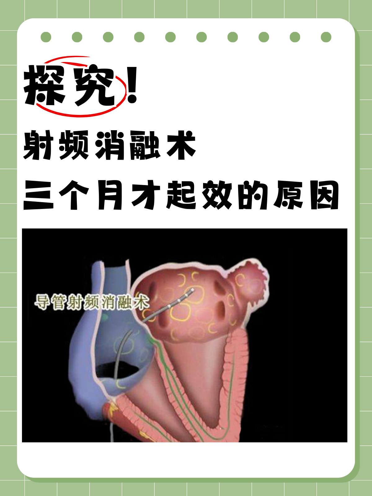 探究射频消融术三个月才起效的原因�