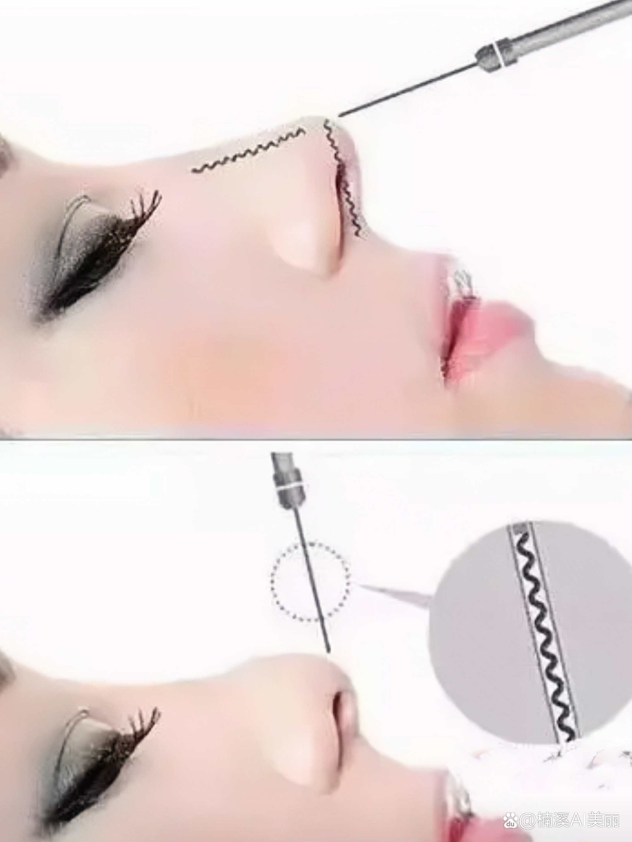  p>线雕鼻的副作用和危害 br> br>线雕鼻是近年来流行的一种鼻整形