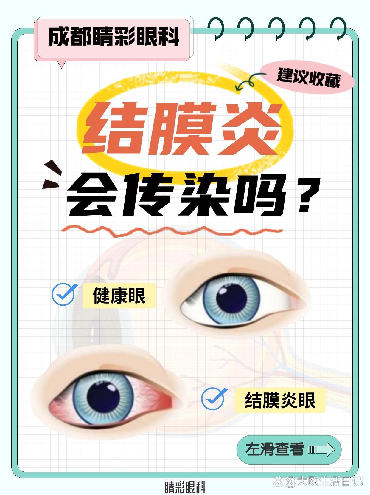 结膜炎真的会传染吗71一文读懂结膜炎7515