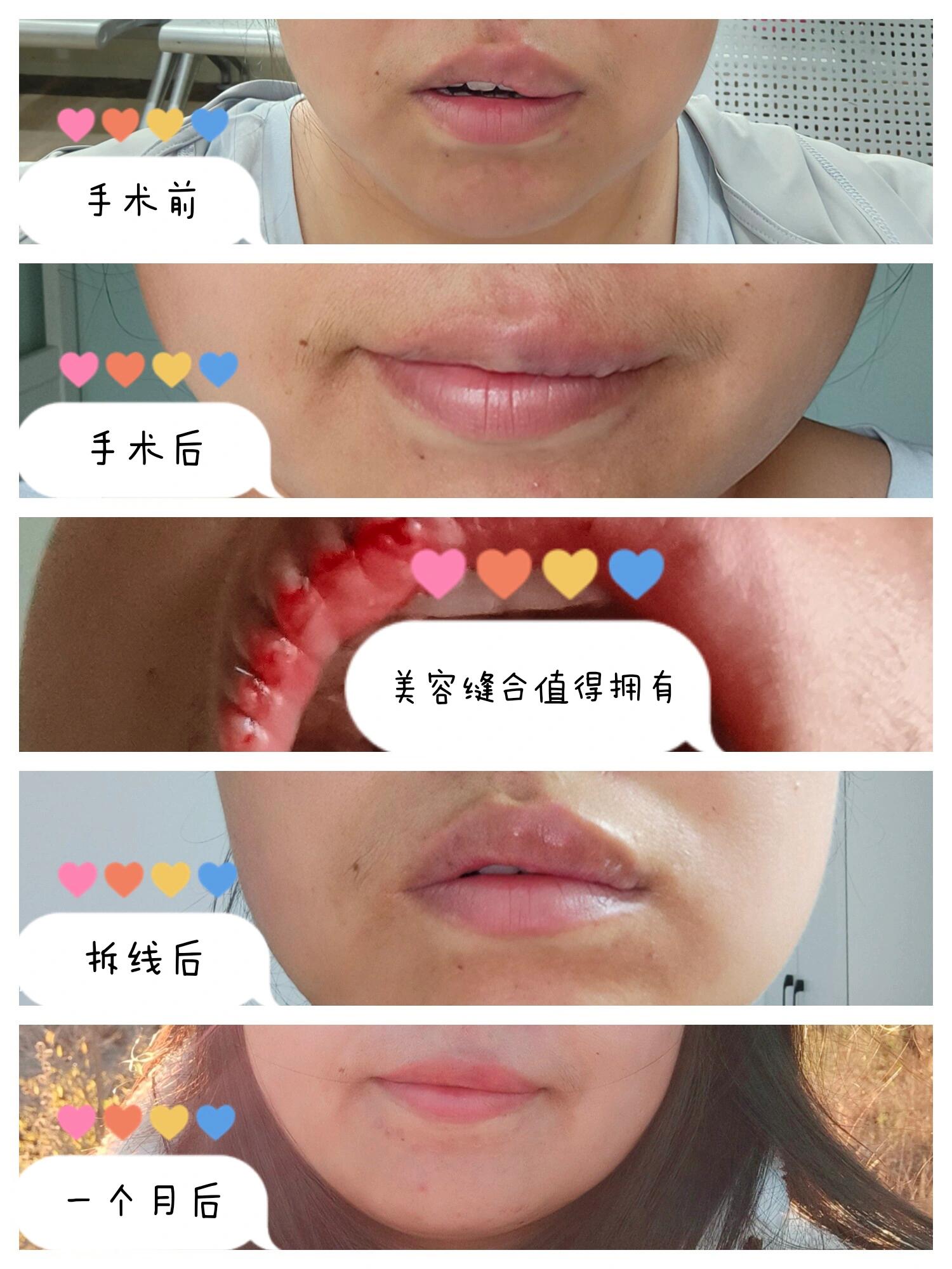 拒绝容貌焦虑(嘴唇修复手术)