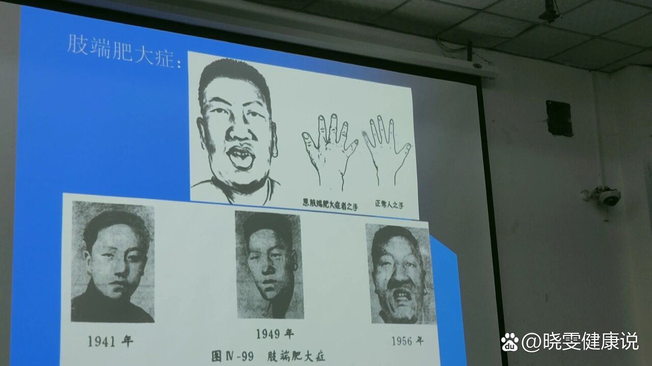 此乃肢端肥大症