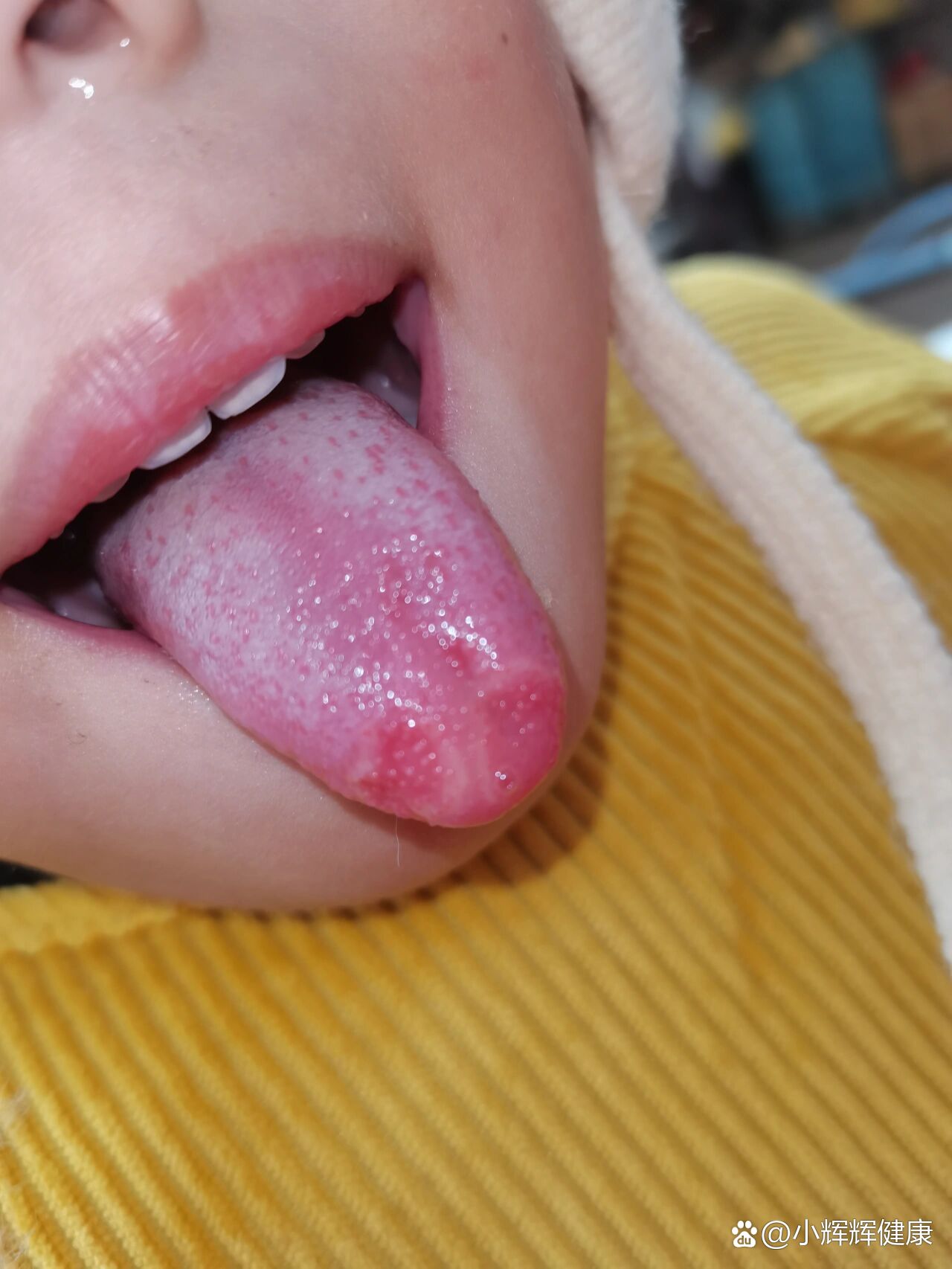 突然最近发现小孩舌头怎么这样了