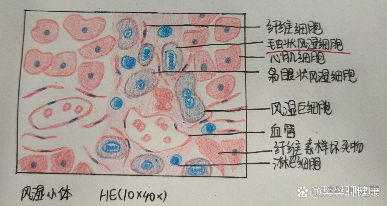 风湿小结图片图片