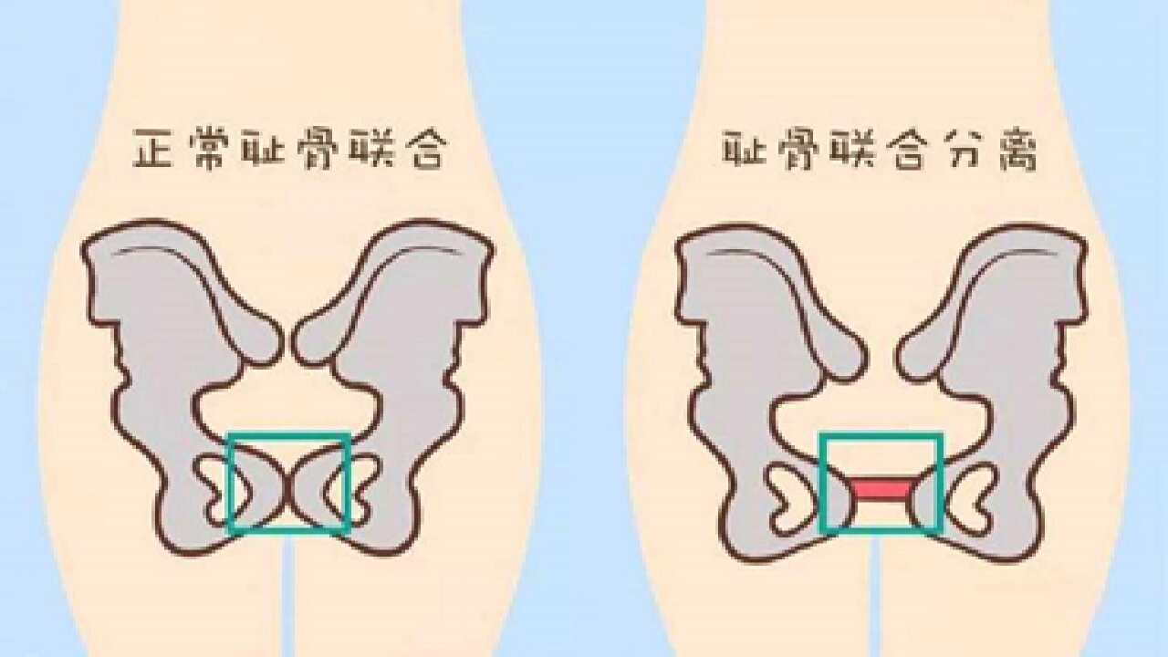 耻骨分离的症状图片图片