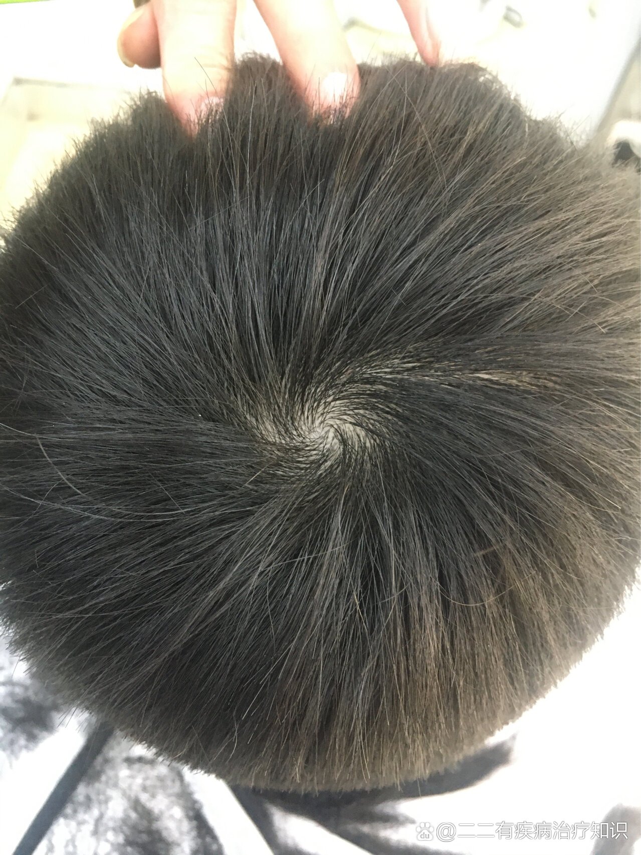 哲哥正圆的头顶,居中的头旋