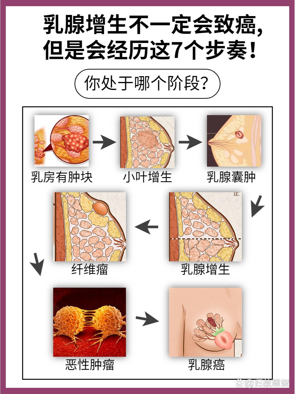 乳腺癌发展的7个步奏7215增生结节必看7515