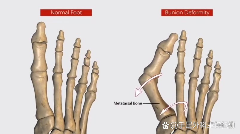 拇外翻是关节移位？