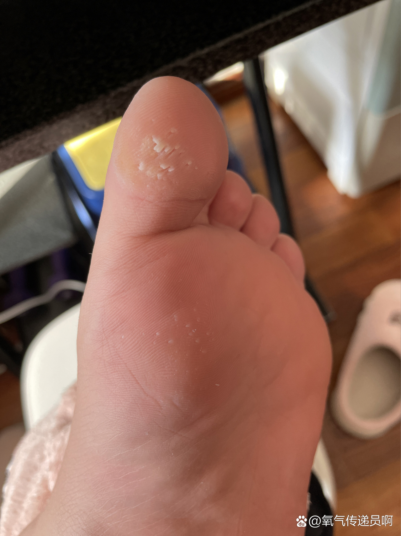 脚底好多小倒刺