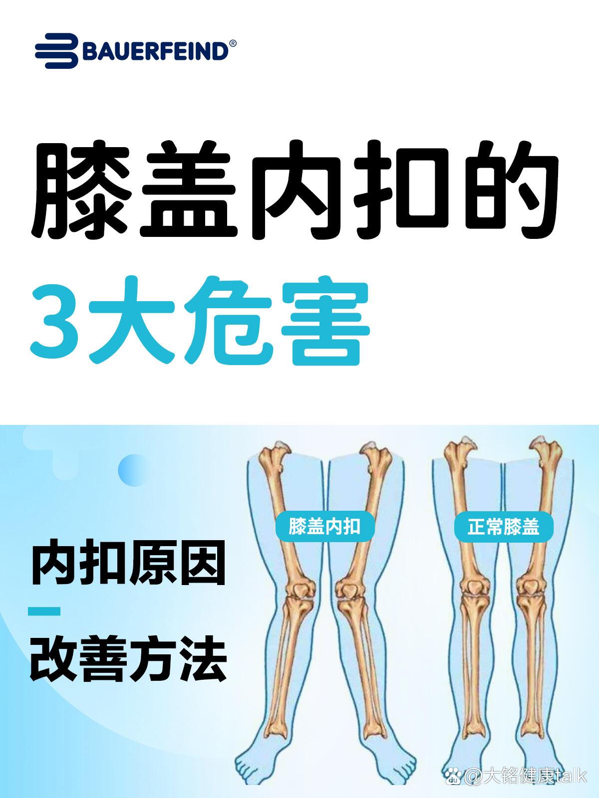 膝盖内扣的3大危害,附矫正方法!