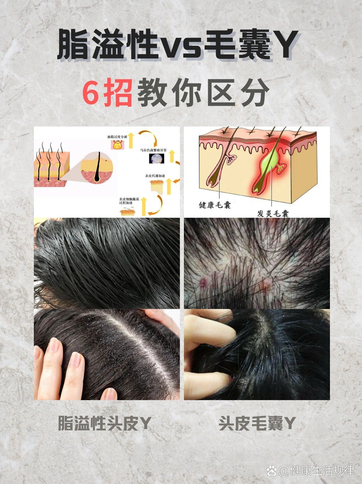 头皮脂溢性和毛囊y,从这6点来区分7515
