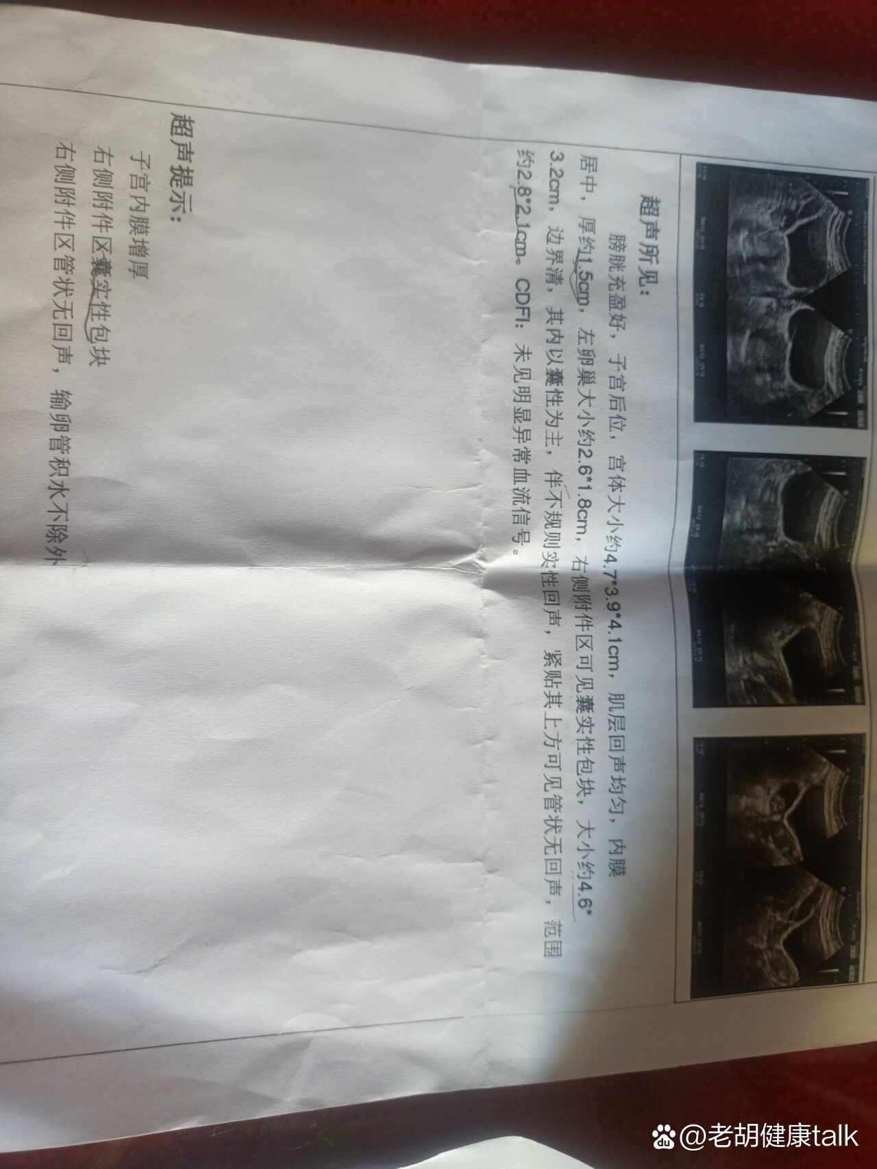 右侧附件区囊性包块