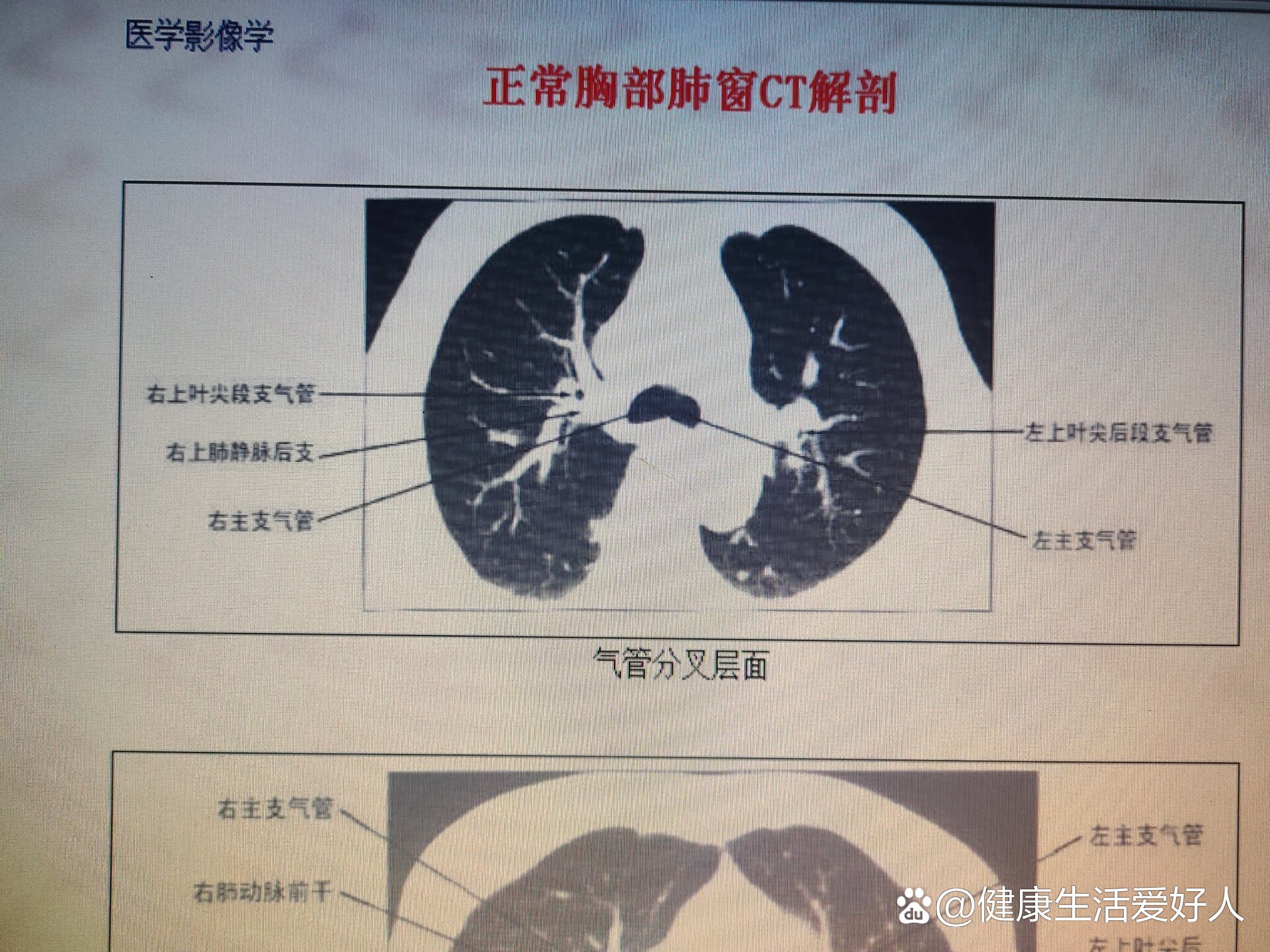 正常的肺门图片大全图片