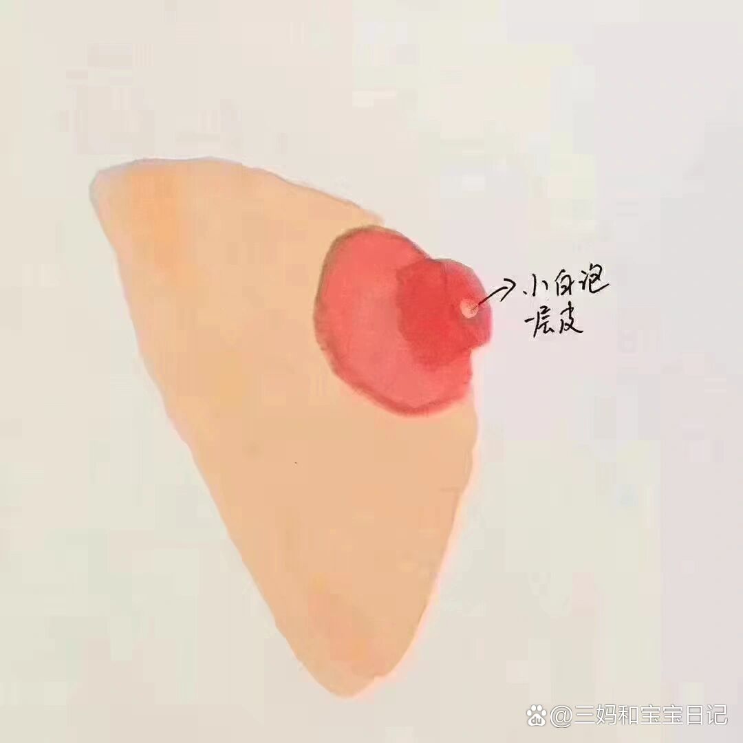 哺乳期乳头小白泡形成的原因及处理