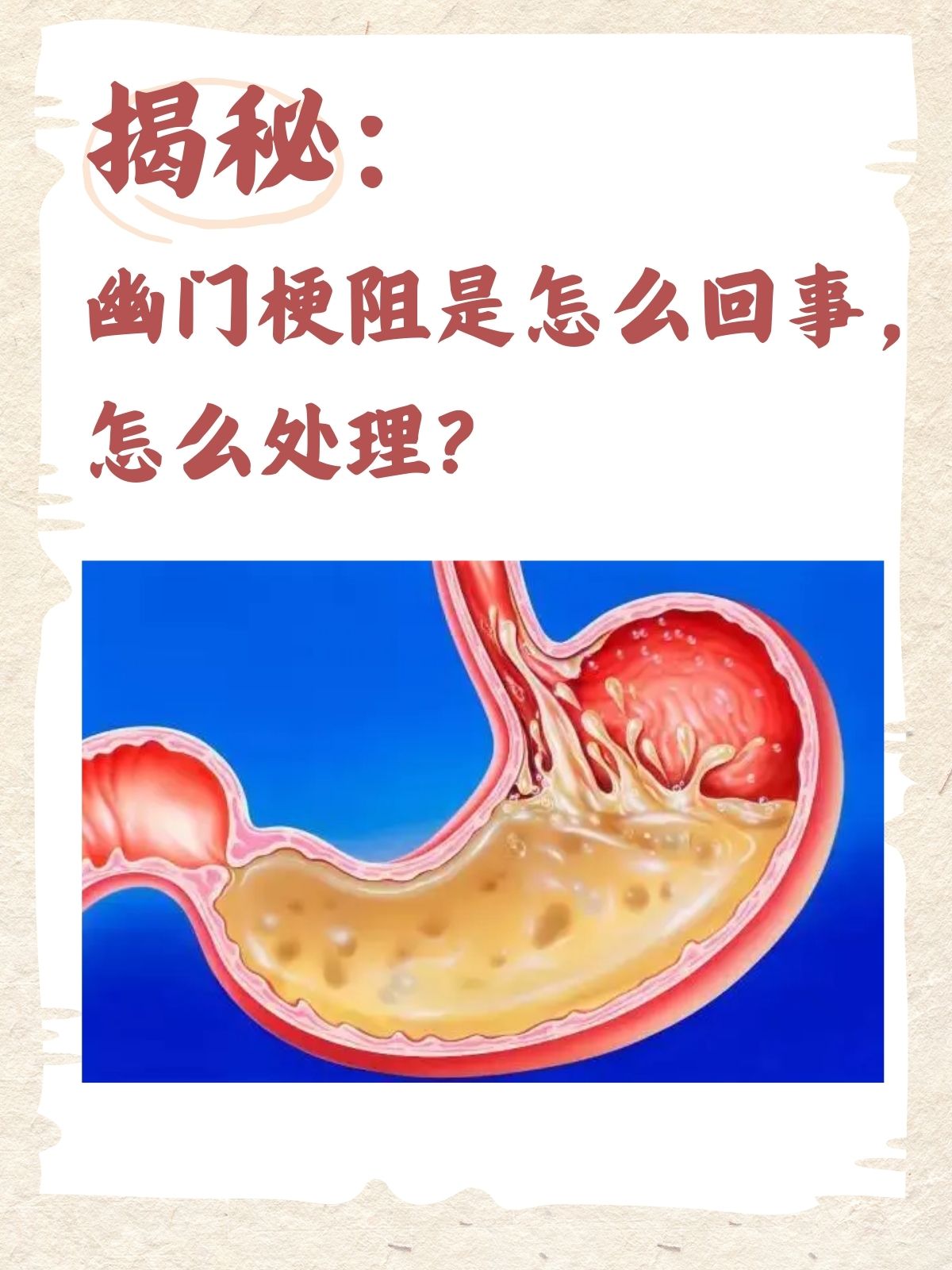 幽门不完全梗阻症状